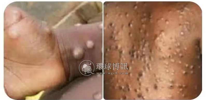 新冠未消 猴痘又袭！缅甸卫生部正采取措施防止猴痘疫情在缅传播